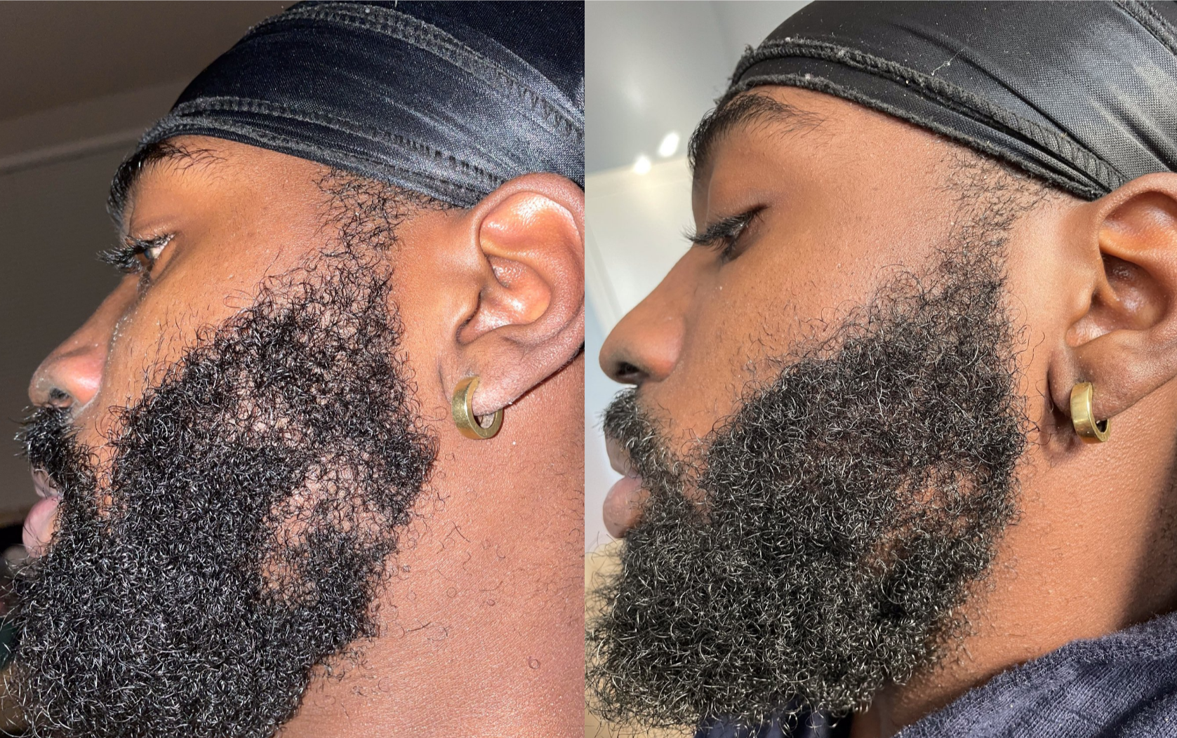 Before and after is shown of a male model and his previously patchy beard and now a more healthy and full beard 2 months after consistent use