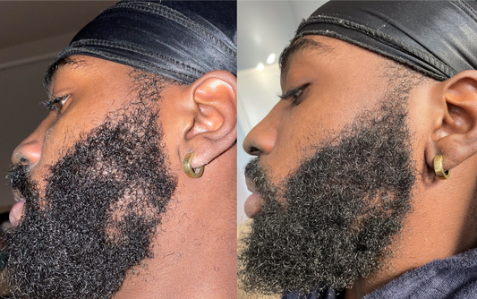 Before and after is shown of a male model and his previously patchy beard and now a more healthy and full beard 2 months after consistent use
