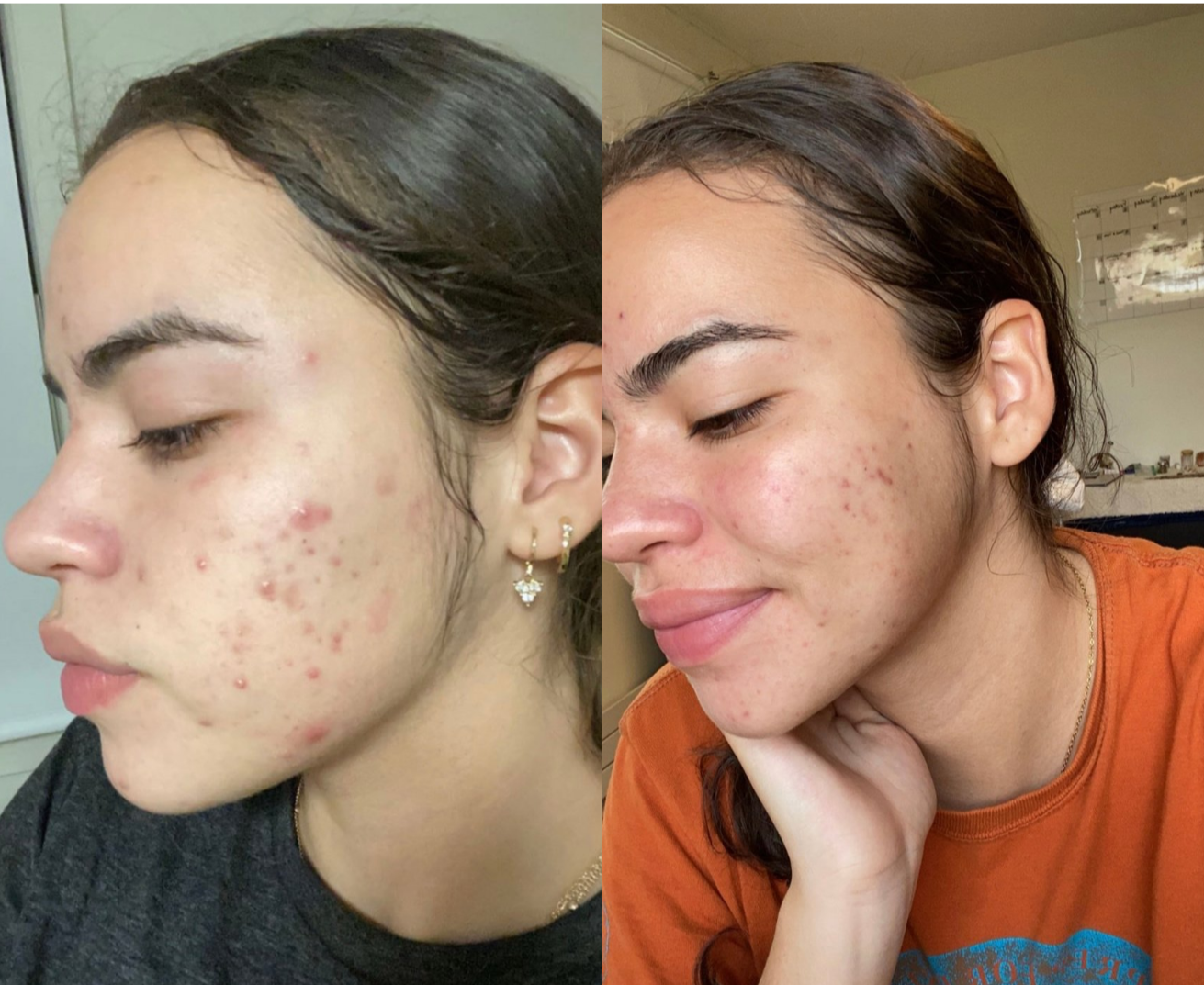 Before and after of a female client having more clear skin due to her usage of the turmeric soap