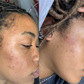 Before and after of a female client having more clear skin due to her usage of the turmeric soap