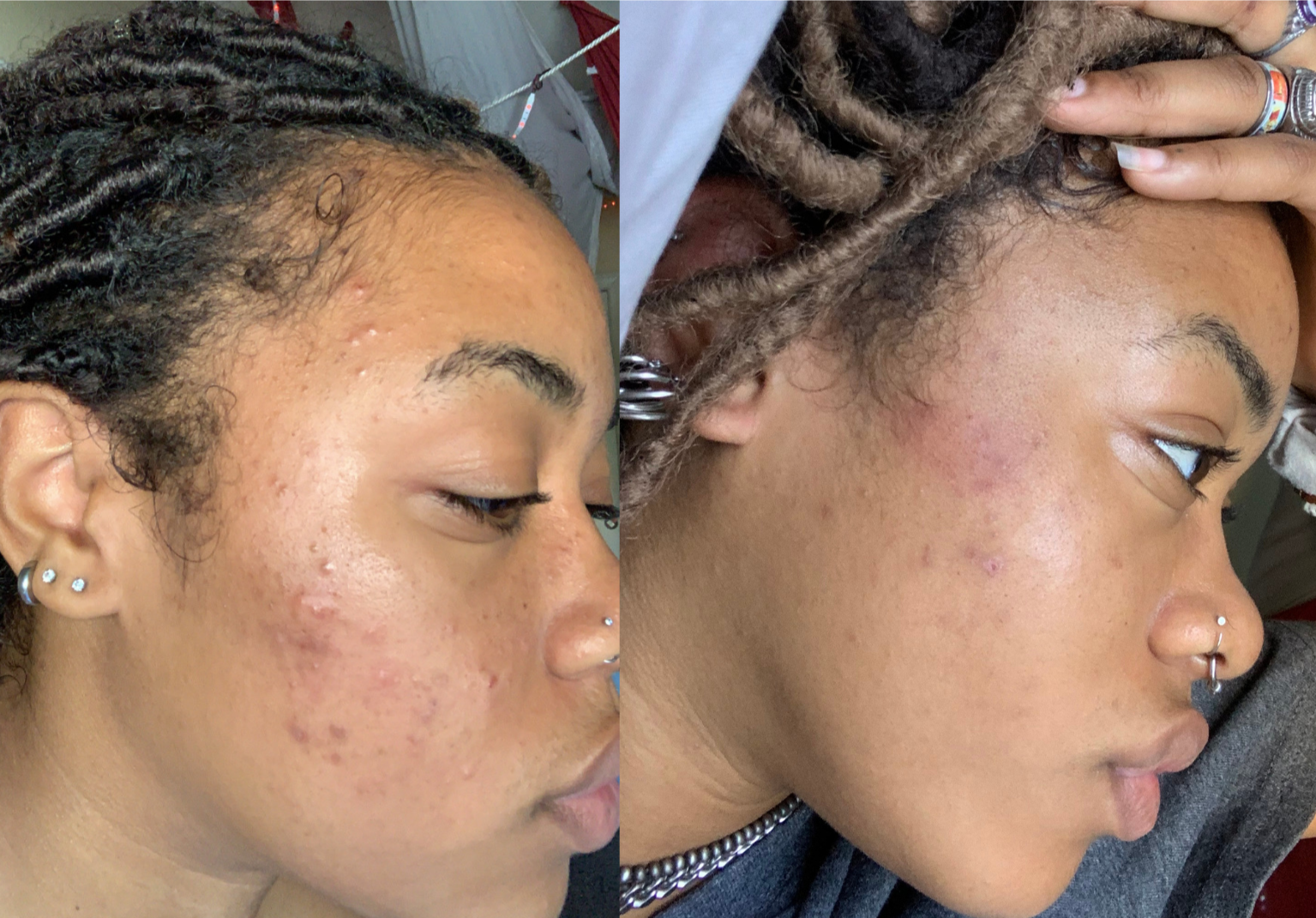 Before and after of a female client having more clear skin due to her usage of the turmeric soap