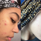 Before and after of a female client having more clear skin due to her usage of the turmeric soap  
