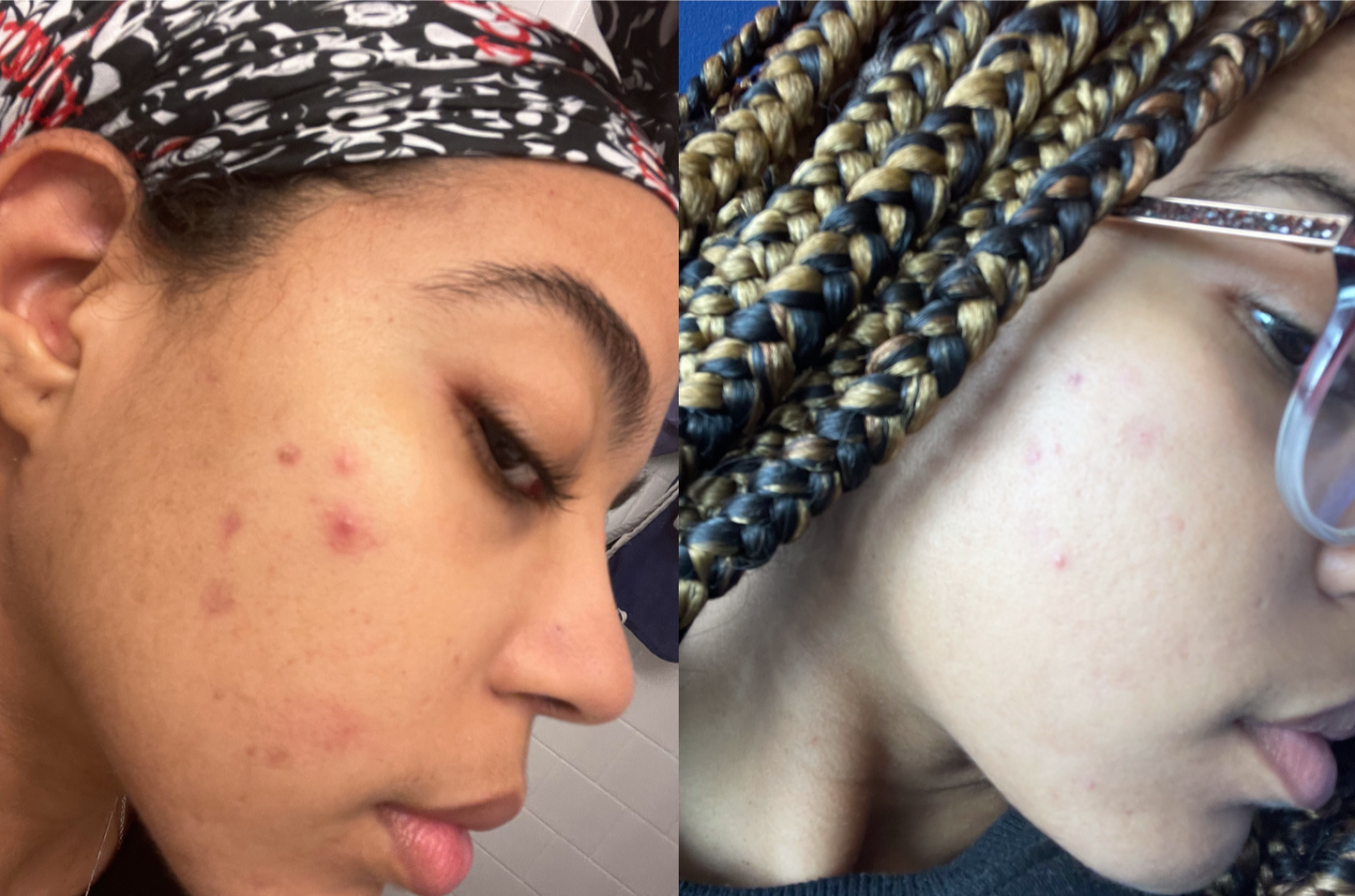 Before and after of a female client having more clear skin due to her usage of the turmeric soap  