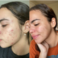 Before and after of a female client having more clear skin due to her usage of the turmeric soap 