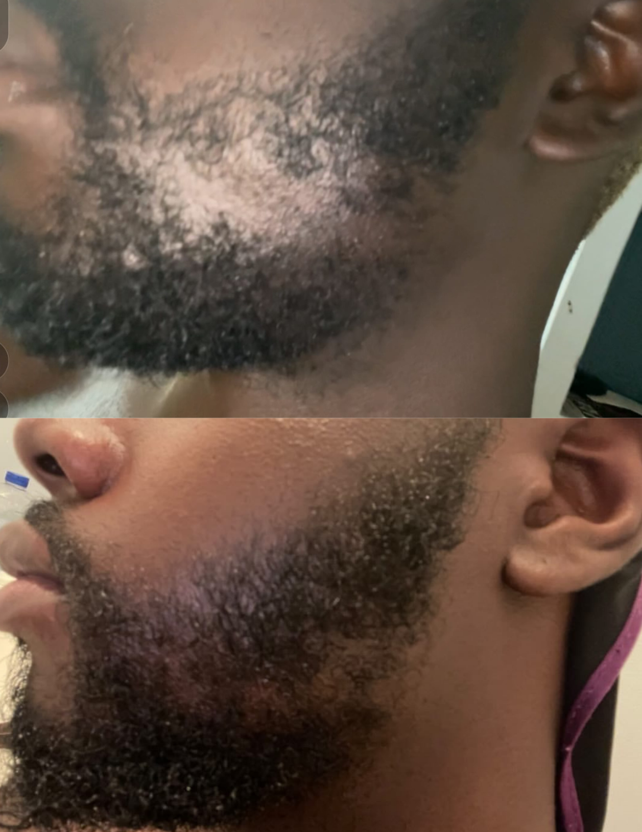 Before and after is shown of a male model and his previously patchy beard and now a more healthy and full beard 